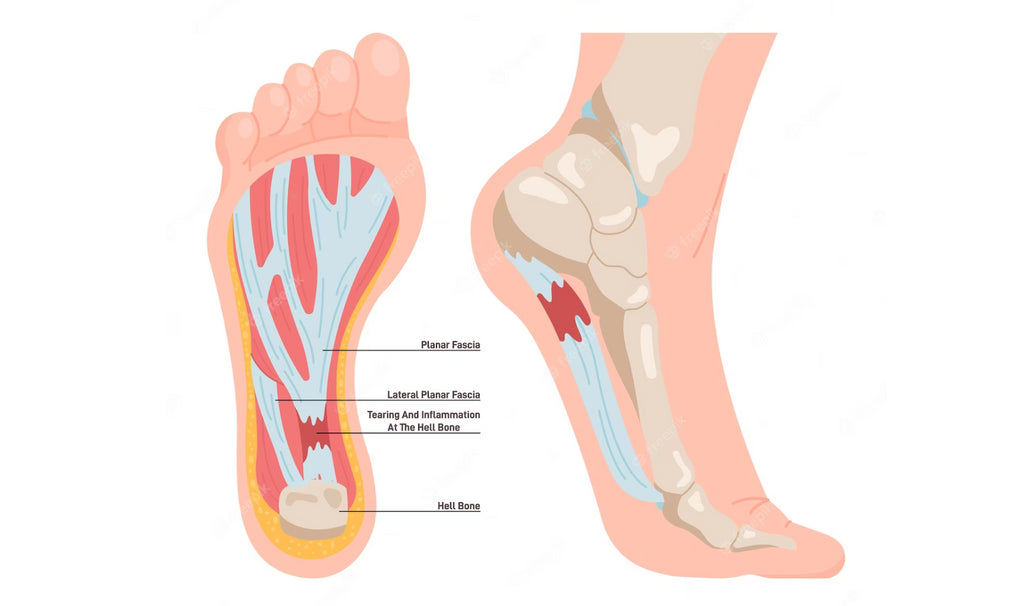 tens unit for plantar fasciitis
